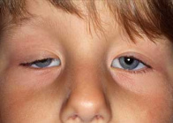 Eine Ptosis (herabh�ngendes
                            Augenlied) kann gut und gerne durch
                            Amalgam-Quecksilber verursacht sein, wenn
                            das Quecksilber die Nerven sch�digt