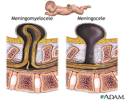 Spina bifida (offener R�cken), Schema
                            des Austritts des R�ckenmarks aus dem
                            R�cken, der durch Quecksilberd�mpfe w�hrend
                            der Schwangerschaft beg�nstigt wird. Die
                            Medizin will diesen Zusammenhang bis heute
                            nicht akzeptieren...