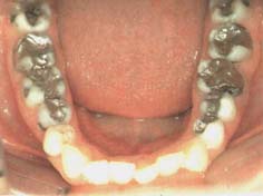 Amalgamgebiss mit Amalgam in
                          Seitenz�hnen
