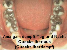 Amalgam dampft Tag und Nacht
                  hochgiftige Quecksilberd�mpfe aus
