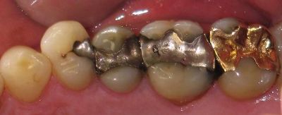 Alte,
                        por�se Amalgamf�llungen: Wenn Amalgamf�llungen
                        kaputt sind, setzen sie besonders viel
                        Quecksilber frei. Das BfArM macht dazu keine
                        Zahlenangaben. Das ist alles andere als
                        "wissenschaftlich"...