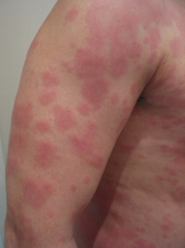 Urtikaria /
Urticaria Urtikaria / Urticaria