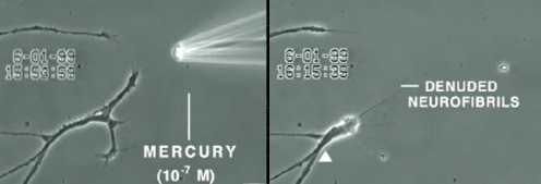 Da�o
                        nervioso (fibra nerviosa) por el mercurio. El
                        mercurio de amalgama impide sistem�ticamente la
                        capacidad de transporte de la tubulina, y as�
                        los nervios se reducen autom�ticamente, y solo
                        quedan fibras nerviosas muertas. A la medicina
                        "convencional" no importa eso, y los
                        gobiernos criminales y adictos de la bolsa
                        siguen a pagar el amalgama y pagan tambi�n los
                        medicamentos contra las enfermedades nerviosas
                        provocadas...