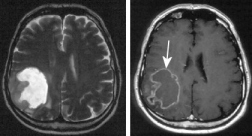 Tumor cerebral, p.e.
                        el glioblastoma. El mercurio da�a a la
                        substancia gen�tica y provoca una aumentaci�n de
                        la formaci�n de radicales libres. Los dos
                        factores pueden provocar la formaci�n de un
                        tumor. Pero a la medicina
                        "convencional" no importa eso, porque
                        m�s tumores provocan m�s trabajo y m�s provecho,
                        y las cajas de salud pagan las dos cosas, el
                        amalgama y las operaciones de tumores. Los
                        gobiernos criminales y adictos a la bolsa no
                        quieren ver eso...