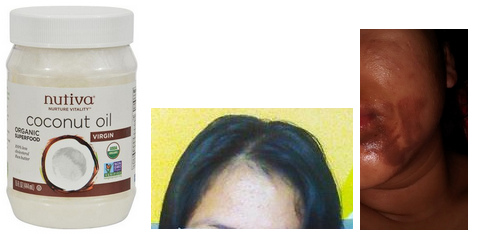 Coconut oil is healing the skin, for
                              example acne and burnings