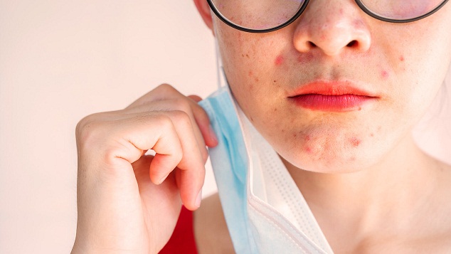 Die ganze
                      Mundpartie ist mit Pickeln �bers�t vom
                      Maskentragen