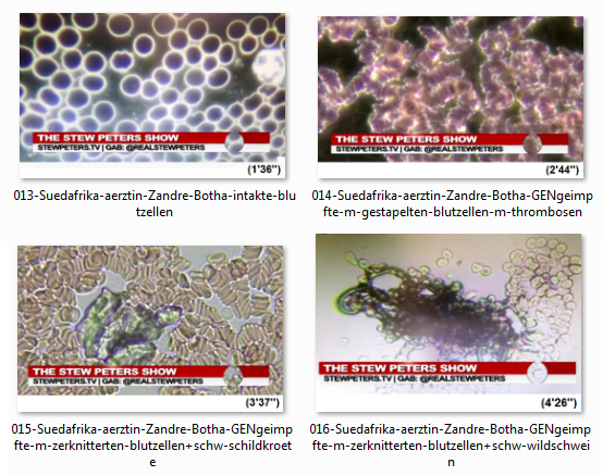 Fotos von gesundem und kaputtem Blut von
GENgeimpften aus Südafrika Fotos von gesundem
und kaputtem Blut von GENgeimpften aus Südafrika