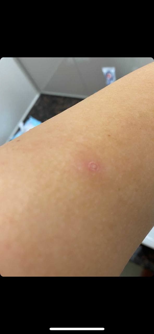 Fleck nach der 2. Genspritze Moderna 01 Fleck nach der 2. Genspritze Moderna 01