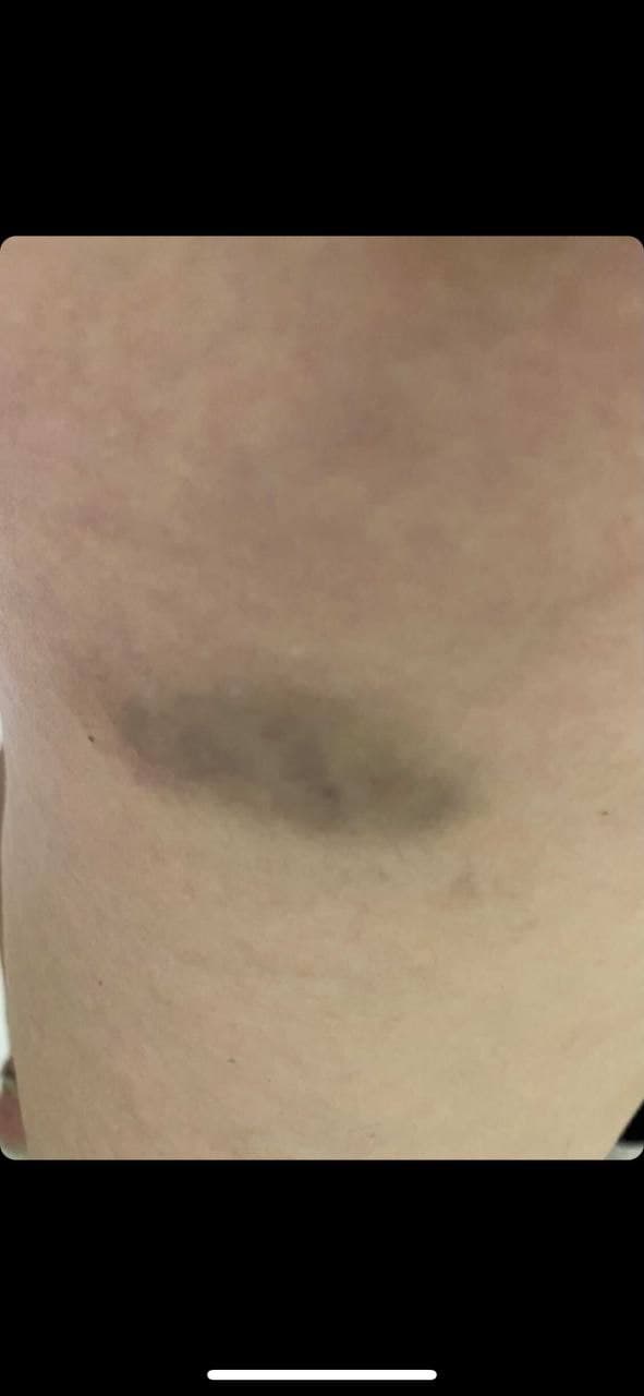 Fleck nach der 2. Genspritze Moderna 02 Fleck nach der 2. Genspritze Moderna 02