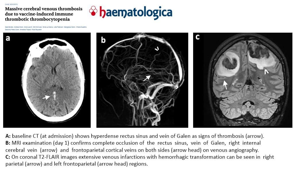 GENimpfschaden 5.9.2021: Frau (27)
GENgeimpft mit Veneninfarkt im Hirn GENimpfschaden 5.9.2021: Frau (27)
GENgeimpft mit Veneninfarkt im Hirn