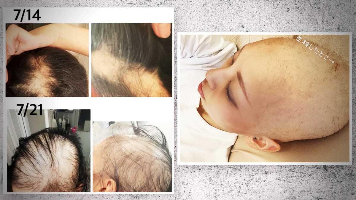 GENimpfschaden Haarausfall in der Schweiz
21.9.2021: Die Leute denken, die Person hat Krebs:
"Alle denken, ich hätte Krebs": Immer mehr
Fälle von schwerem Haarausfall nach Impfung GENimpfschaden Haarausfall in der Schweiz
21.9.2021: Die Leute denken, die Person hat Krebs:
"Alle denken, ich hätte Krebs": Immer mehr
Fälle von schwerem Haarausfall nach Impfung