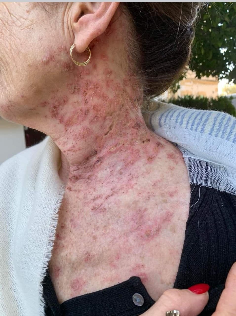 GENimpfschaden Gürtelrose 9.1.2022 02 GENimpfschaden Gürtelrose 9.1.2022 02