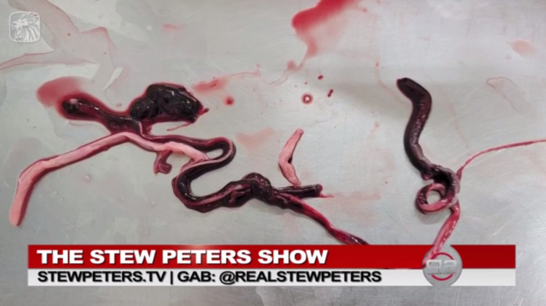 GENimpfung provoziert weisse, gummiartige
Blutgerinnsel, Meldung von UncutNews am 31.1.2022,
grosses Foto 01 GENimpfung provoziert
weisse, gummiartige Blutgerinnsel, Meldung von
UncutNews am 31.1.2022, grosses Foto 01