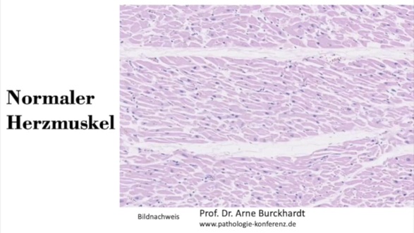 Herzmuskel in gesundem Zustand:
                  Alle Fasern sind parallel