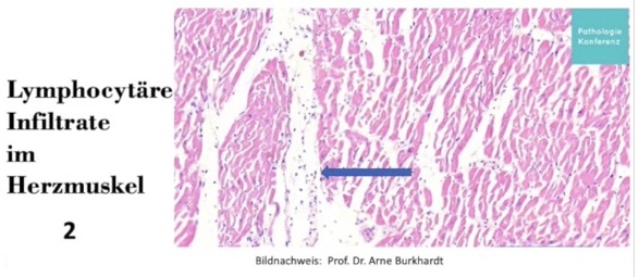 Herzmuskel nach
                  Herzmuskelentz�ndung mit T-Lymphozyten im Gewebe