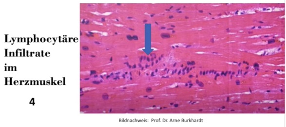 Herz nach
                  Herzmuskelentz�ndung: T-Lymphozyten stapeln sich im
                  Muskel wie Geldrollen