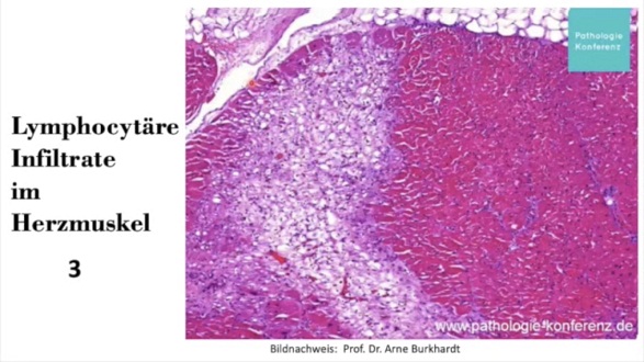 Herz nach
                  Herzmuskelentz�ndung: T-Lymphozyten decken im Muskel
                  ganze Bereiche ab
