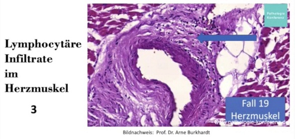 Herz nach Herzmuskelentz�ndung:
                  Entz�ndungen an den Gef�ssw�nden