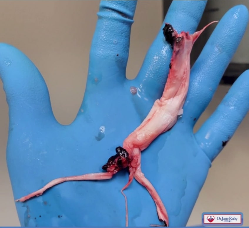 SCHLANGENGIFTimpfschaden "USA"
13.5.2022: Weisses Faserblutgerinnsel von
Einbalsamierer Richard Hirschmann SCHLANGENGIFTimpfschaden "USA"
13.5.2022: Weisses Faserblutgerinnsel von
Einbalsamierer Richard Hirschmann