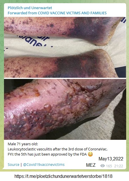 SCHLANGENGIFTimpfschaden "USA"
13.5.2022: Bläschenausschlag mit abgestorbenem,
nekrotischen Gewebe: Male 71 years old:
Leukocytoclastic vasculitis after the 3rd dose of
CoronaVac SCHLANGENGIFTimpfschaden
"USA" 13.5.2022: Bläschenausschlag mit
abgestorbenem, nekrotischen Gewebe: Male 71 years old:
Leukocytoclastic vasculitis after the 3rd dose of
CoronaVac