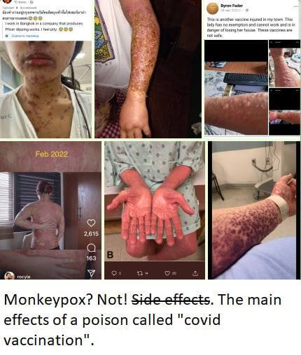 SCHLANGENGIFTimpfschaden weltweit 20.5.2022:
Hautflechen und Hautblasen SCHLANGENGIFTimpfschaden weltweit 20.5.2022:
Hautflechen und Hautblasen