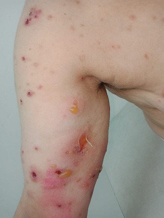 Hautsch�den durch SCHLANGENGIFTimpfung in
                  Kalifornien ("USA") 4.6.2022: 5 F�lle 3a