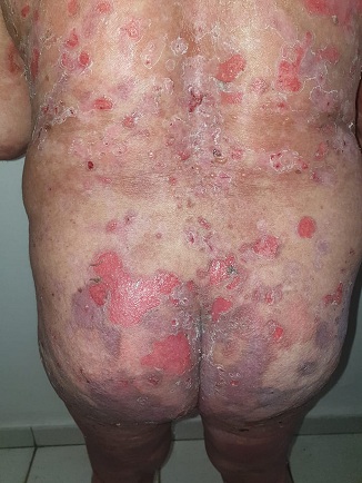 Hautsch�den durch SCHLANGENGIFTimpfung in
                  Kalifornien ("USA") 4.6.2022: 5 F�lle 05