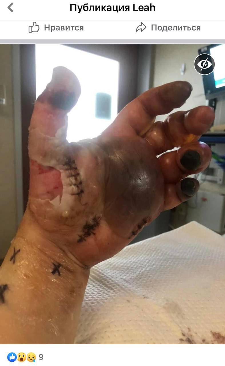 SCHLANGENGIFTimpfschaden ohne Ort 15.6.2022:
Hand fault ab mit Gangrän SCHLANGENGIFTimpfschaden ohne Ort 15.6.2022: Hand
fault ab mit Gangrän