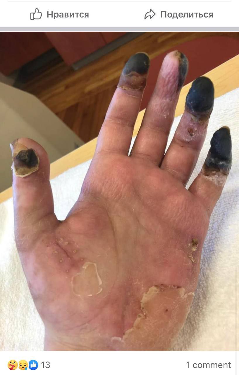 SCHLANGENGIFTimpfschaden ohne Ort
15.6.2022: Hand fault ab mit Gangrän SCHLANGENGIFTimpfschaden ohne Ort
15.6.2022: Hand fault ab mit Gangrän