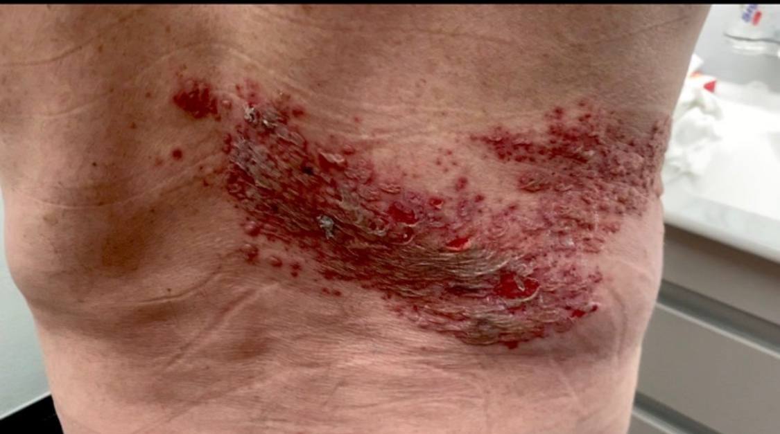 SCHLANGENGIFTimpfschaden Schweiz 2.7.2022:
Gürtelrose SCHLANGENGIFTimpfschaden Schweiz
2.7.2022: Gürtelrose