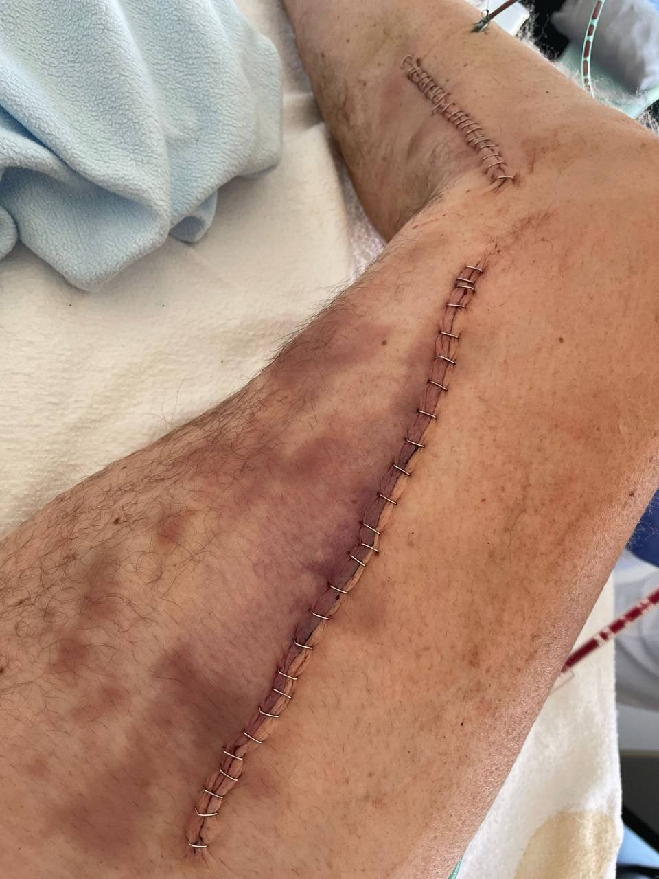 SCHLANGENGIFTimpfschaden ohne Ort 1.8.2022:
Beinthrombose rausgeholt SCHLANGENGIFTimpfschaden ohne Ort 1.8.2022:
Beinthrombose rausgeholt