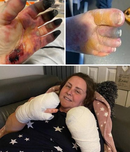 SCHLANGENGIFTimpfschaden Schottland 23.8.2022:
Frau komplett "geimpft": Finger schwarz - 8
Finger amputiert: Vollständig geimpfte Frau lässt sich
aufgrund einer "mysteriösen Krankheit" 8
Finger amputieren SCHLANGENGIFTimpfschaden
Schottland 23.8.2022: Frau komplett
"geimpft": Finger schwarz - 8 Finger
amputiert: Vollständig geimpfte Frau lässt sich
aufgrund einer "mysteriösen Krankheit" 8
Finger amputieren