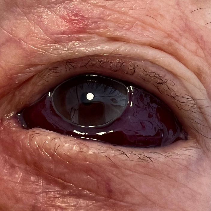 Verdacht SCHLANGENGIFTschaden Schweiz
31.8.2022: Auge wird schwarz durch Niesen Verdacht SCHLANGENGIFTschaden Schweiz
31.8.2022: Auge wird schwarz durch Niesen