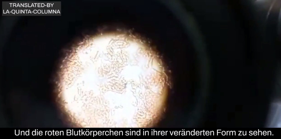 Geimpfte Person wahrsch. aus Argentinien:
Blutprobe unter dem Mikroskop, Blutschaden gestapelte
rote Blutkörperchen und Fremdkörper im Blut 2 Geimpfte Person wahrsch. aus Argentinien:
Blutprobe unter dem Mikroskop, Blutschaden gestapelte
rote Blutkörperchen und Fremdkörper im Blut 2