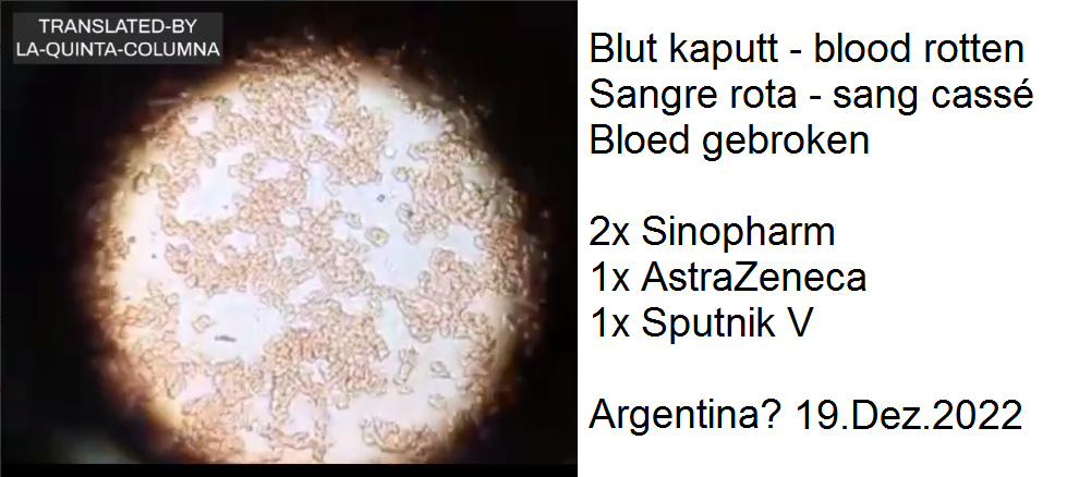 Blutschaden in Argentinien 18.12.2022: Person
4x geimpft: Blutkörperchen kleben
aneinander+Fremdkörper Blutschaden in
Argentinien 18.12.2022: Person 4x geimpft:
Blutkörperchen kleben aneinander+Fremdkörper