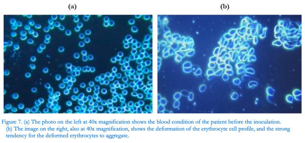 Intaktes Blut VOR der "Coronaimpfung"
(links) - Blutschaden durch "Coronaimpfung"
mit Zusammenballung der roten Blutkörperchen (rechts) Intaktes Blut VOR der "Coronaimpfung"
(links) - Blutschaden durch "Coronaimpfung"
mit Zusammenballung der roten Blutkörperchen (rechts)