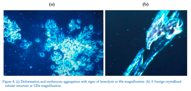Blutschaden durch "Coronaimpfung" in
GB: Zusammenballung+Zerstörung roter Blutkörperchen
(links), kristallisierte Struktur (rechts) Blutschaden durch "Coronaimpfung" in
GB: Zusammenballung+Zerstörung roter Blutkörperchen
(links), kristallisierte Struktur (rechts)