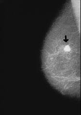 Der Organismus der Blutgruppe AB ist
                              anf�llig f�r die meisten Krebsarten wie
                              Blutgruppe A: Alle Krebsarten, die
                              A-�hnliche Zellen haben.