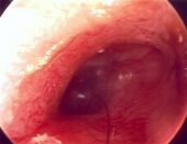 Entz�ndungen (hier eine Entz�ndung des
                          Geh�rgangs) werden durch eine Ern�hrung gegen
                          die Blutgruppe sehr beg�nstigt