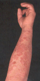 Schuppenflechte wird durch Ern�hrung
                          gegen die Blutgruppe provoziert, vor allem bei
                          Blutgruppe 0