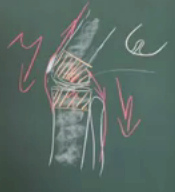 K�nstliches Kniegelenk (rot straffierte
                        Bereiche)