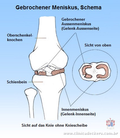 Meniskusknorpel gebrochen, Schema