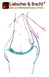 Skizze mit Gelenk und
                                      Muskelkraft und Gegenkr�ften,
                                      Knorpel mit Sinovialfl�ssigkeit