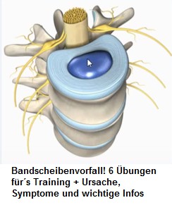 Bandscheiben, Faserring und
                                        Gallertkern, Schema
