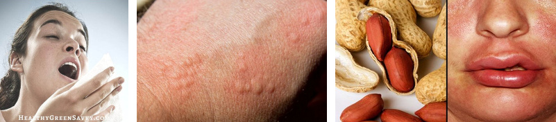 Die
                              Rothschild-Zivilisation mit den vielen
                              Gift-Impfungen provoziert Allergien, und
                              die Hom�opathie heilt Allergien.
                              Niesallergien, Hautallergien,
                              Lebensmittelallergien etc.