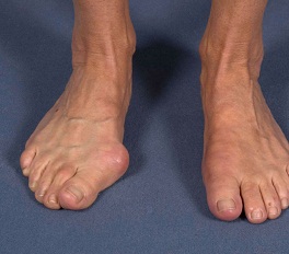 Hallux
                    Valgus