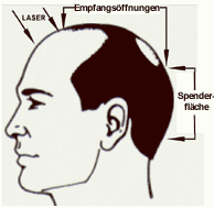 Kahlstelle und Spenderfl�che