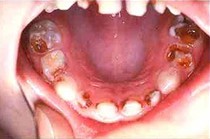 Caries
                      es reducica con b�rax