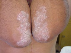 Psoriasis (p.e. en los codos) cura con b�rax