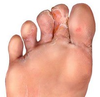 Hongos
                      en el pie curan con b�rax